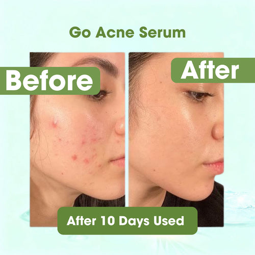 Acne Clear Serum ingredient highlight — Salicylic Acid and Zinc PCA formula