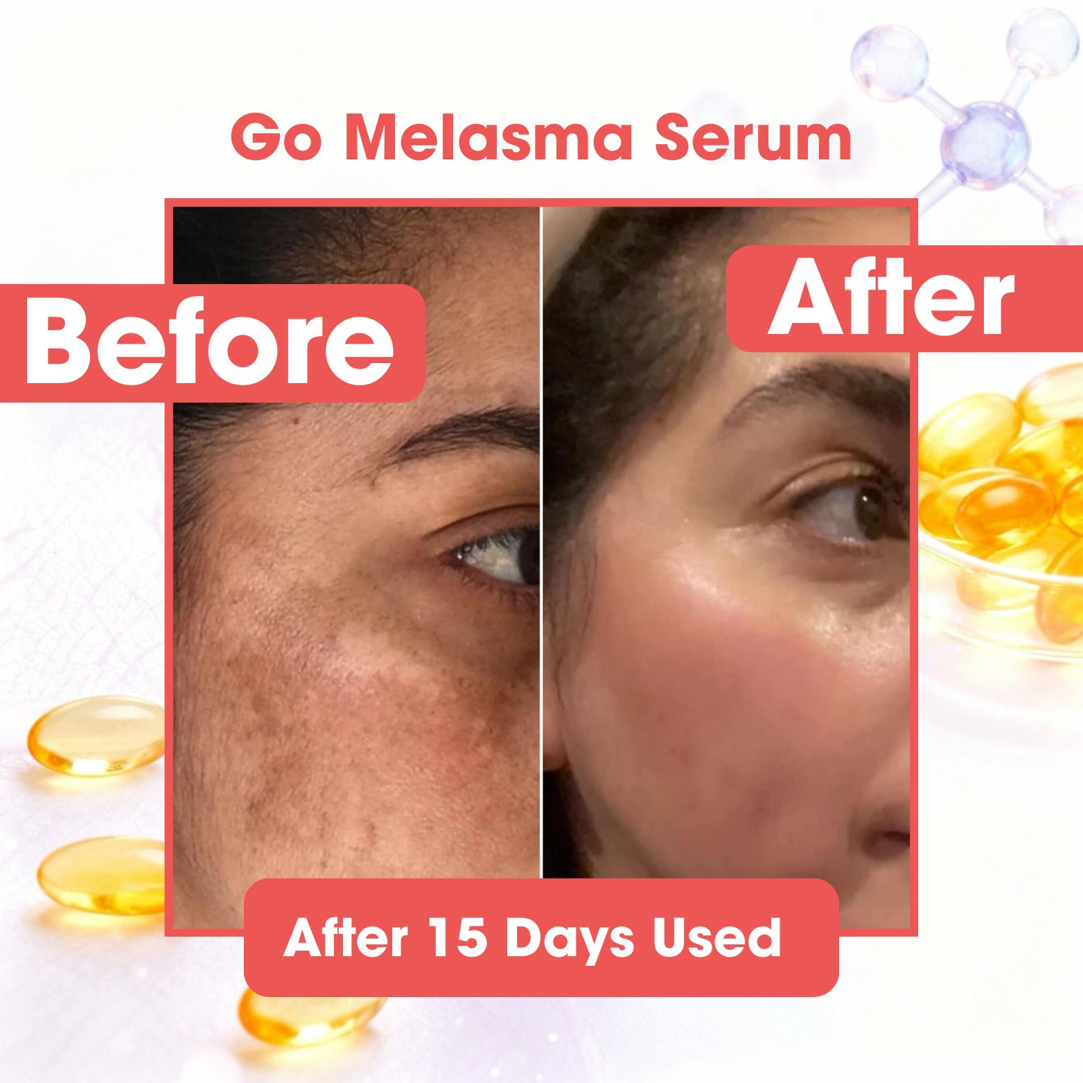 Hyper-Pigmentation, Anti-Melasma, Acne Scars Face Serum